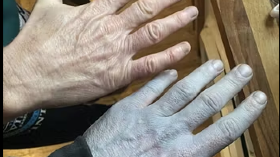 Ra në gjumë shëndosh e mirë, zgjohet i gjithi blu, rasti qesharak në Britani