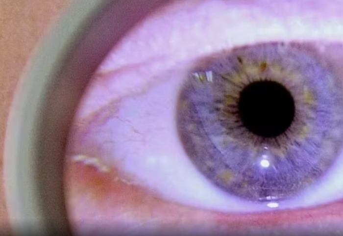 Krijohet lentja e kontaktit “smart”, monitoron dhe kuron sëmundjet e syrit